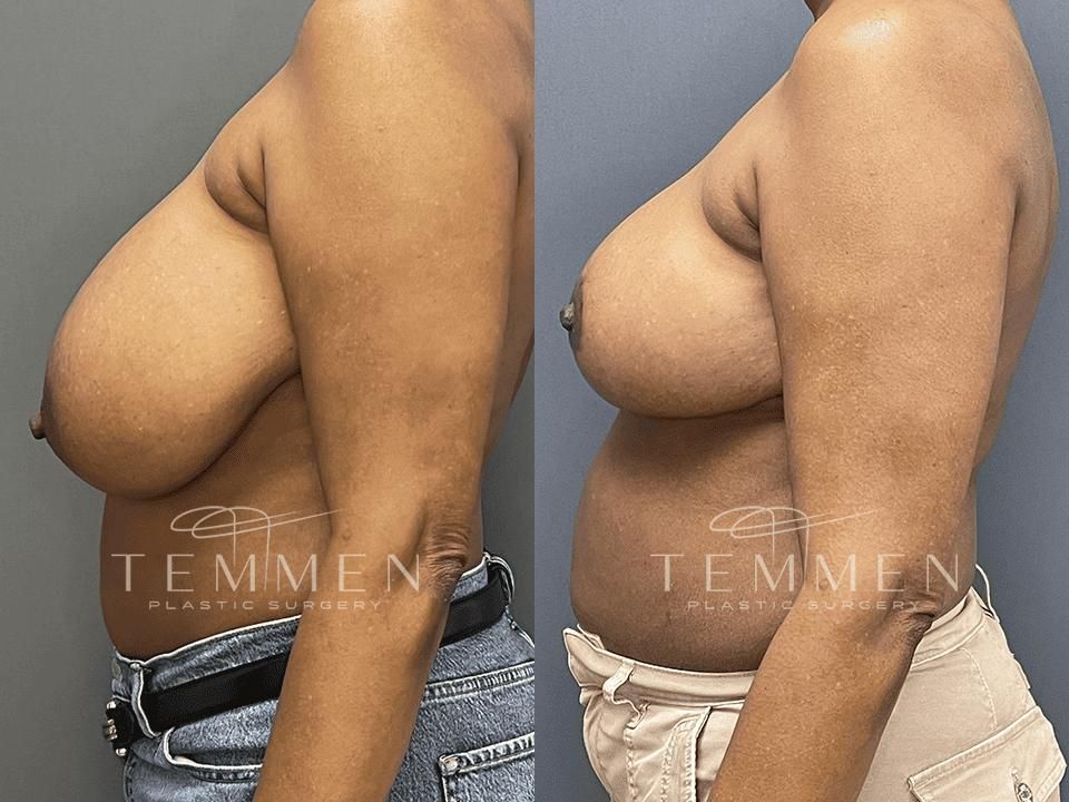 Breast Reduction Before & After