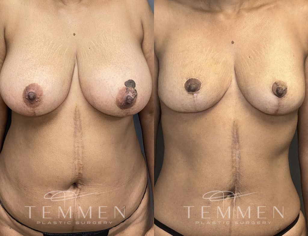 Breast Reduction Before & After