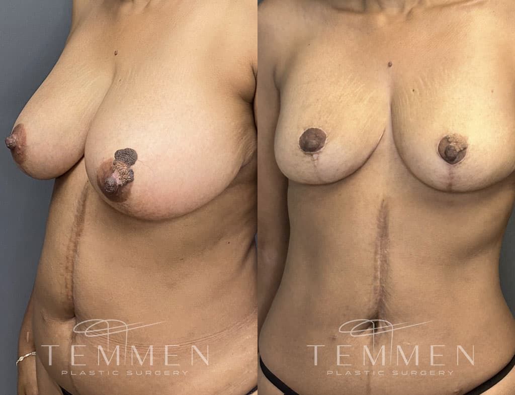 Breast Reduction Before & After