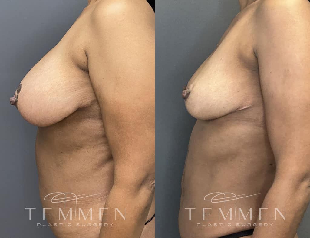 Breast Reduction Before & After