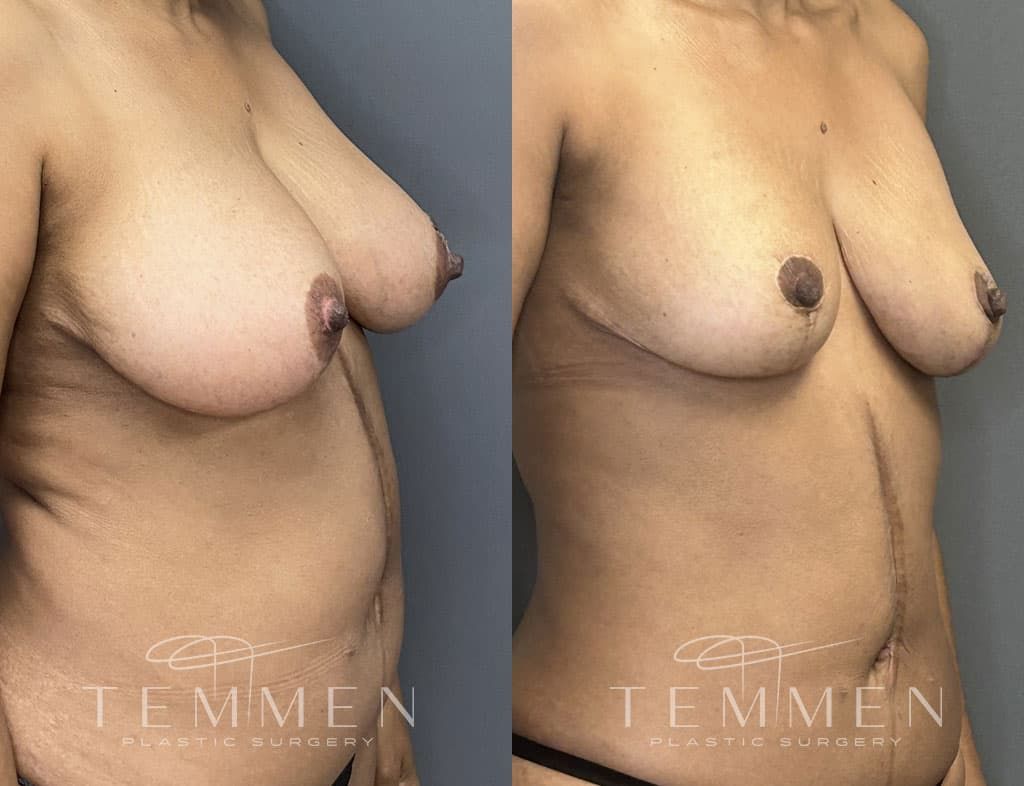 Breast Reduction Before & After