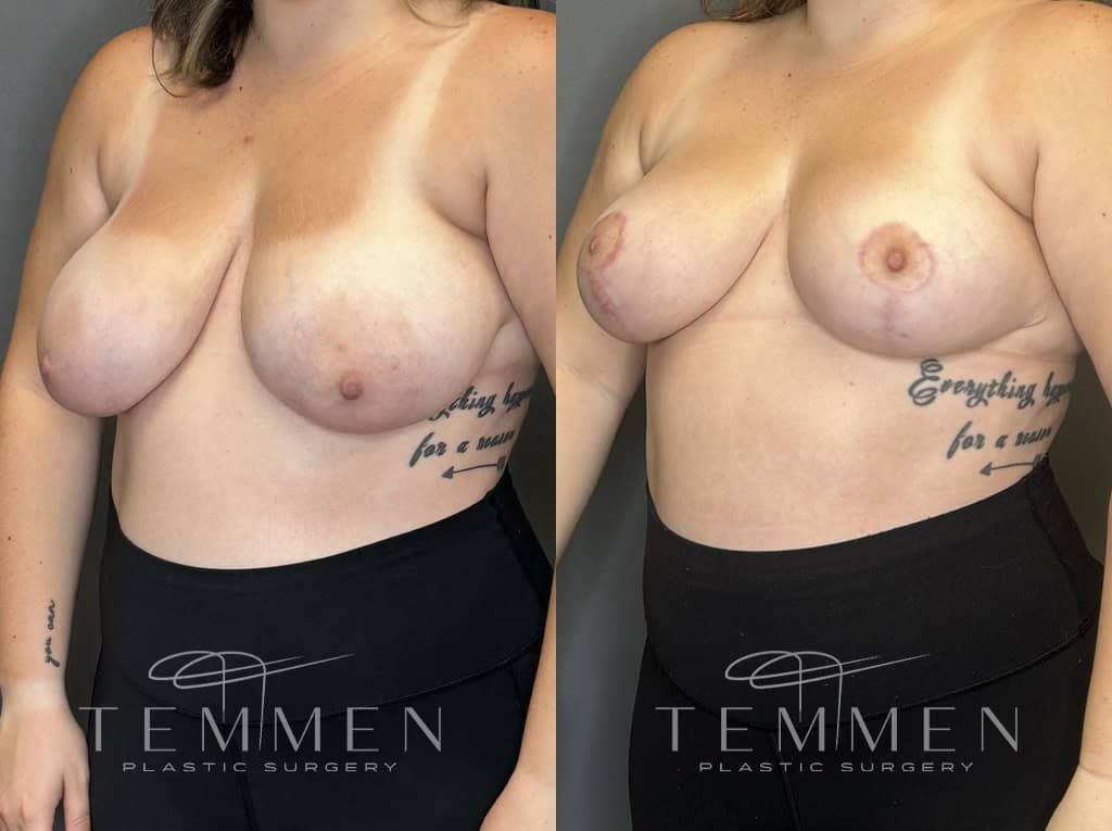 Breast Reduction Before & After