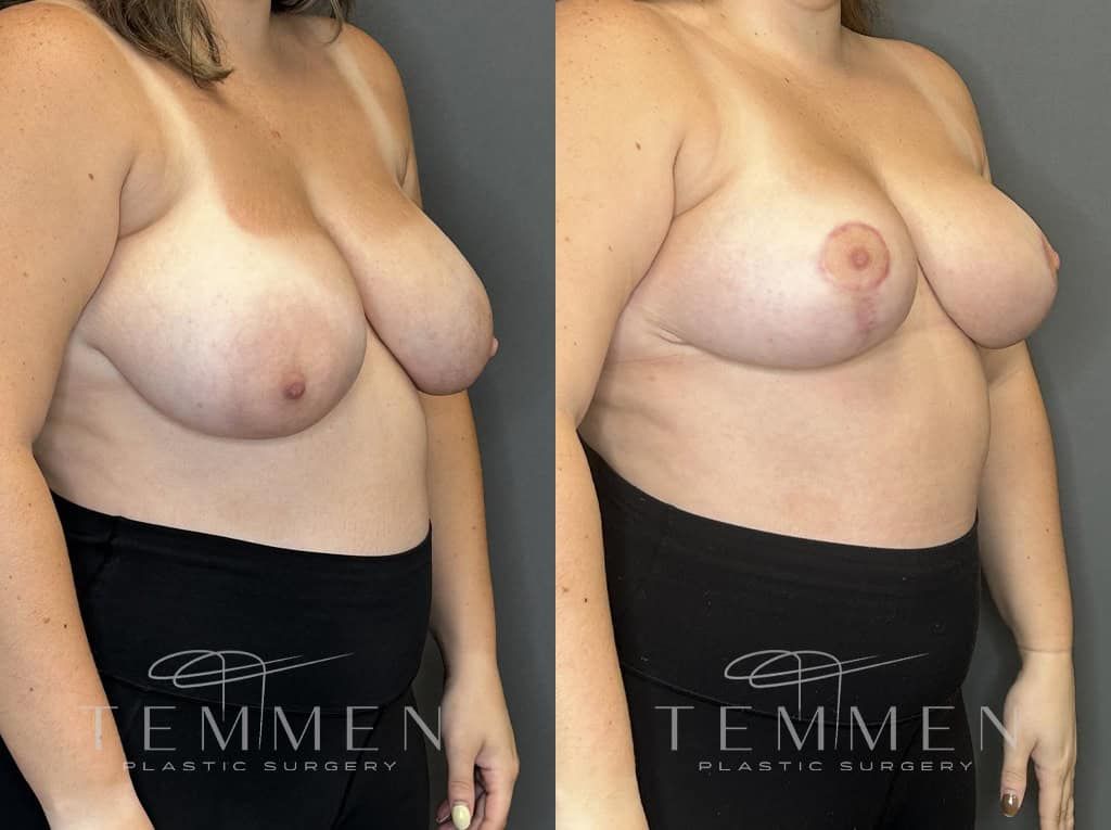 Breast Reduction Before & After