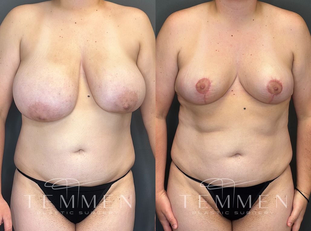 Breast Reduction Before & After