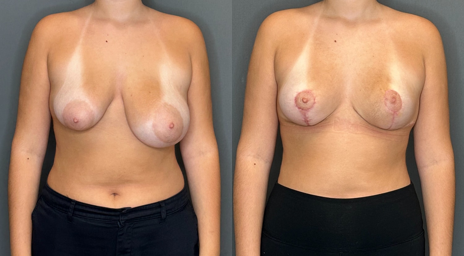 Breast Reduction Before & After