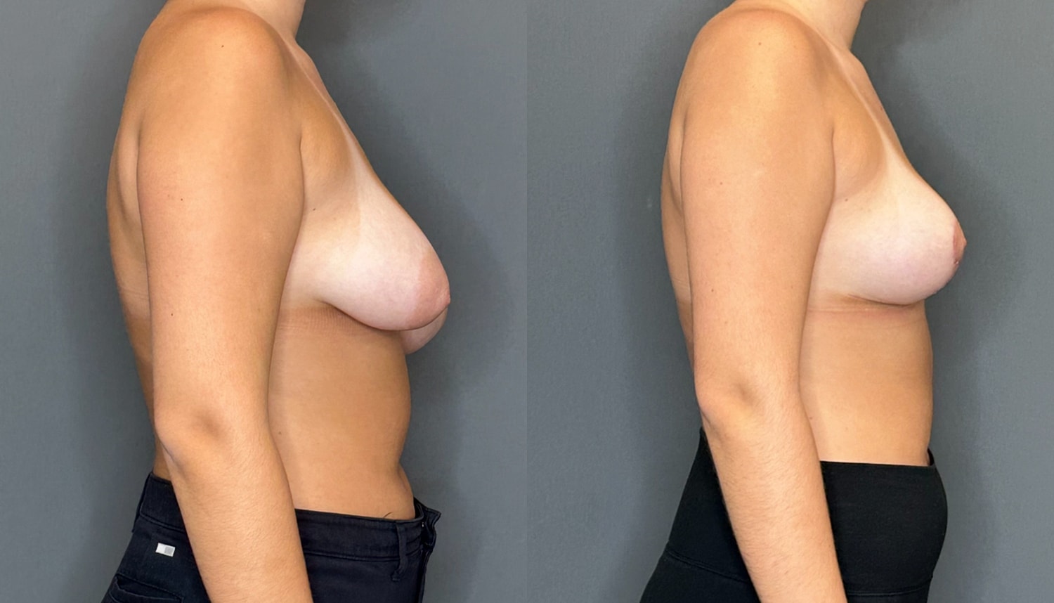 Breast Reduction Before & After