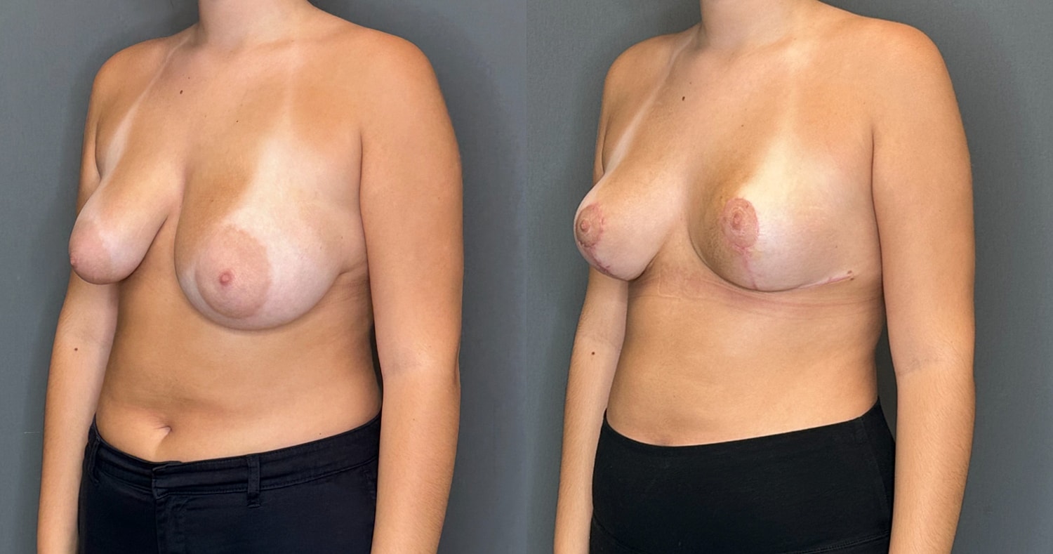 Breast Reduction Before & After