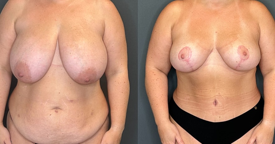 Breast Reduction Before & After