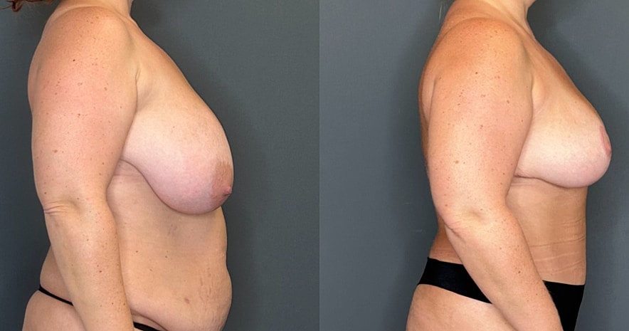 Breast Reduction Before & After