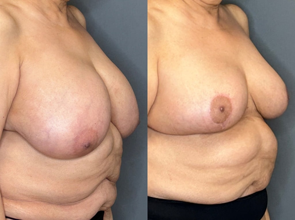 Breast Reduction Before & After