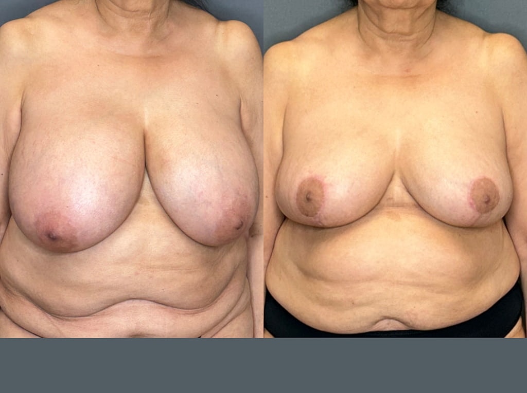 Breast Reduction Before & After
