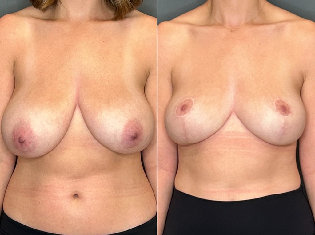 Breast Reduction Before & After
