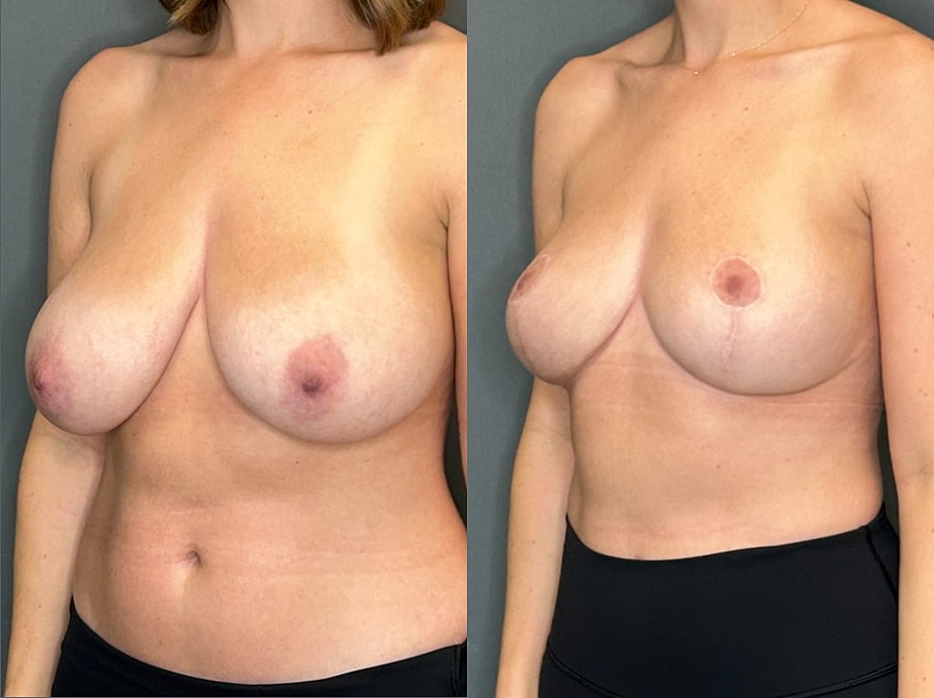 Breast Reduction Before & After