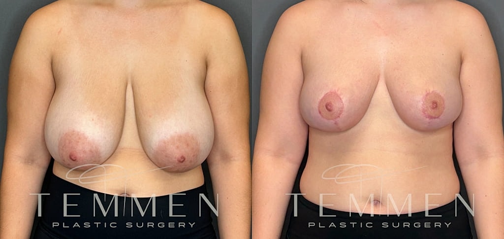 Breast Reduction Before & After