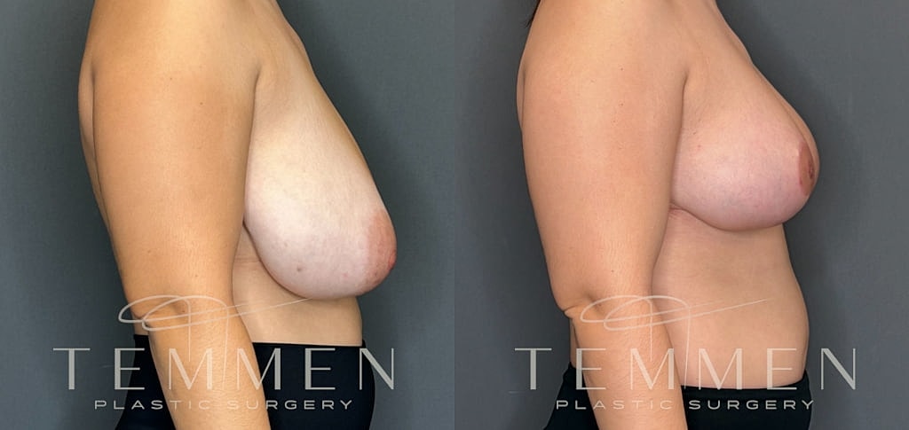 Breast Reduction Before & After