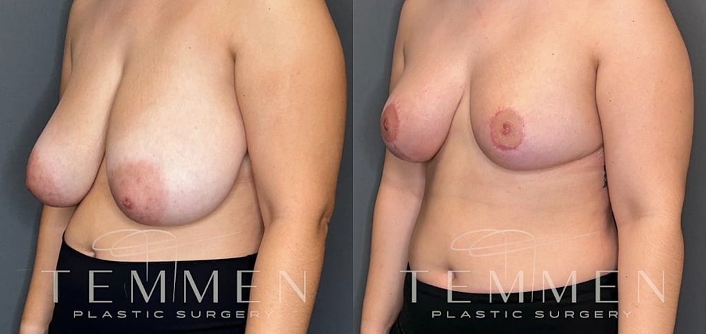 Breast Reduction Before & After