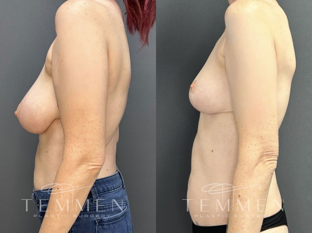 Breast Reduction Before & After