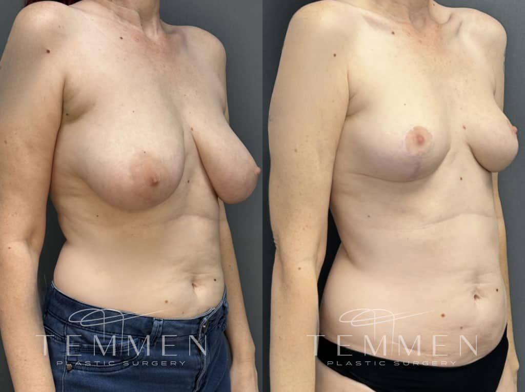 Breast Reduction Before & After