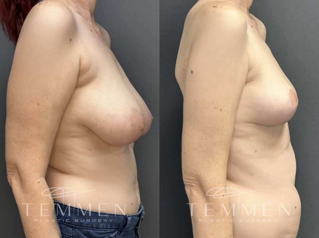 Breast Reduction Before & After