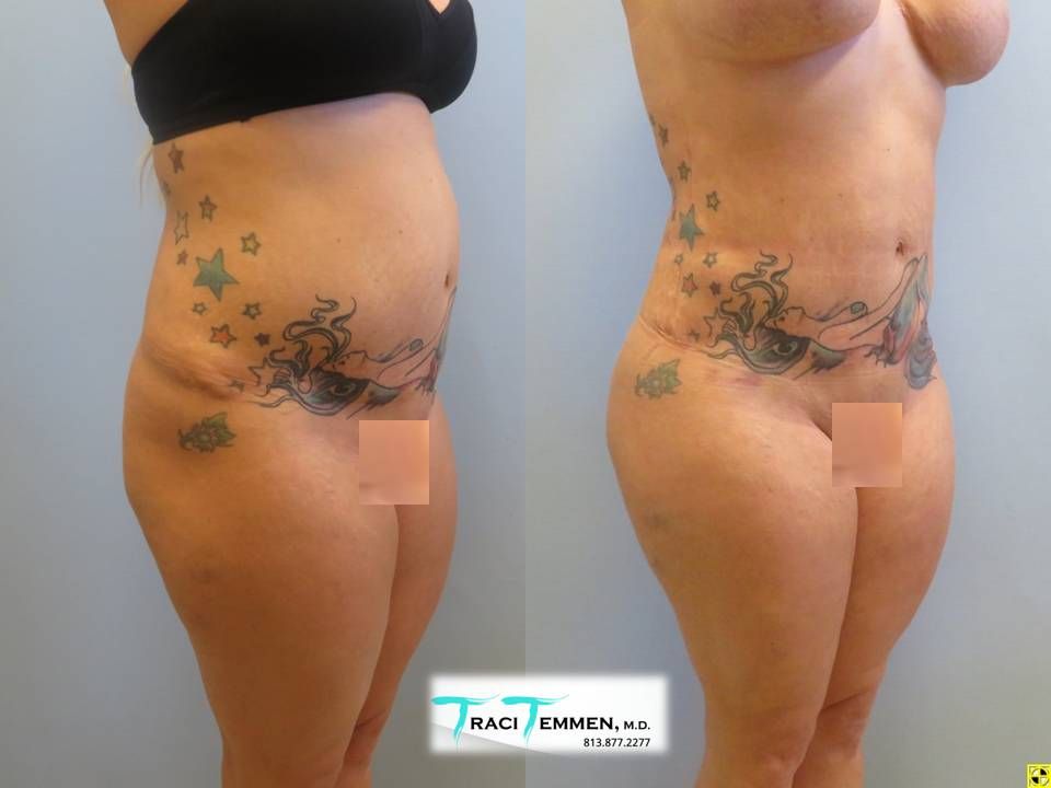 Brazilian Butt Lift Revision Before & After