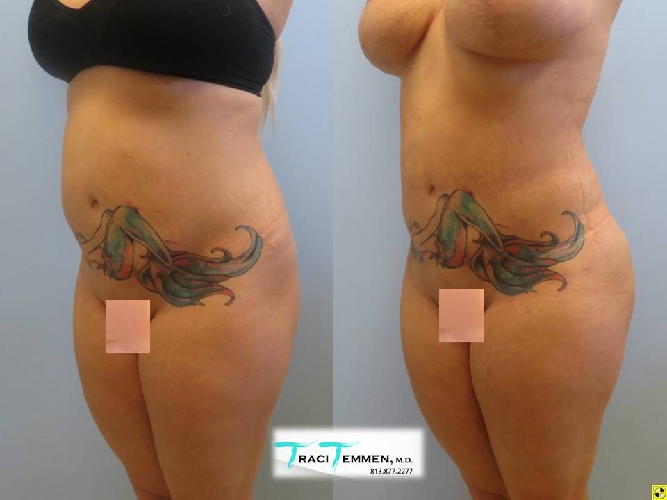 Brazilian Butt Lift Revision Before & After