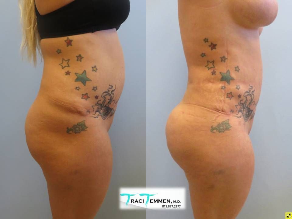 Brazilian Butt Lift Revision Before & After