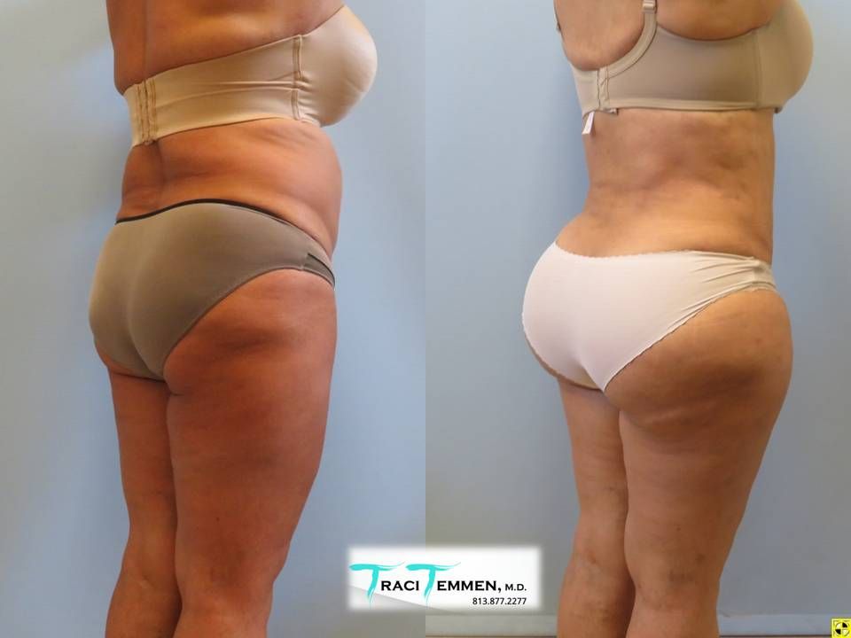 Brazilian Butt Lift Revision Before & After