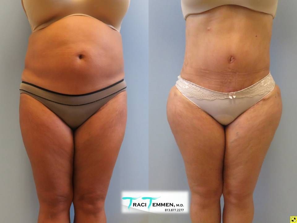 Brazilian Butt Lift Revision Before & After