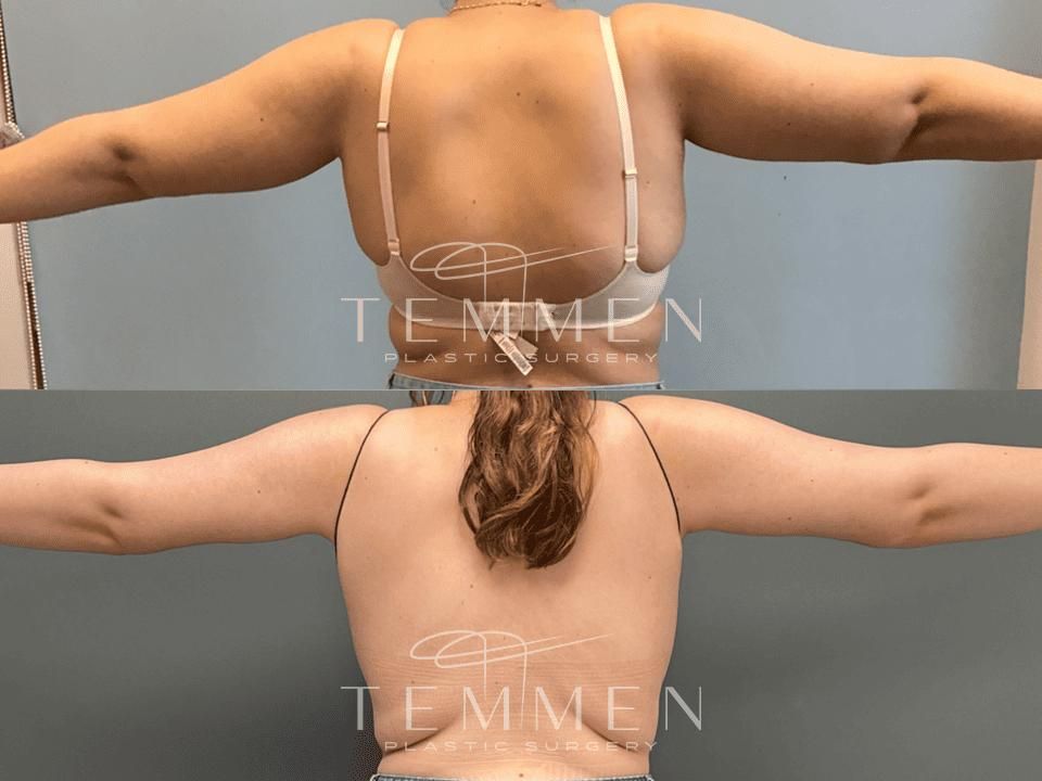 Arm Lift Before & After