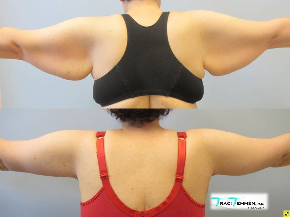 Arm Lift Before & After