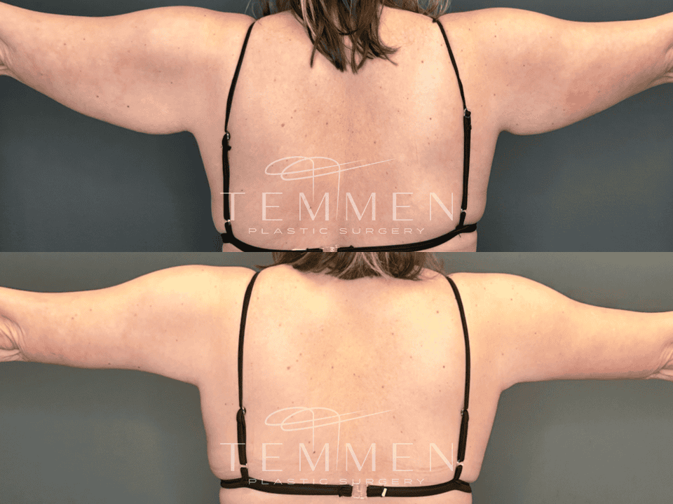 Arm Lift Before & After