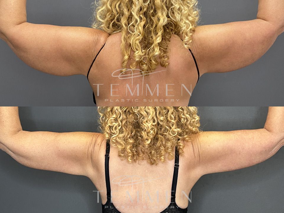 Arm Lift Before & After