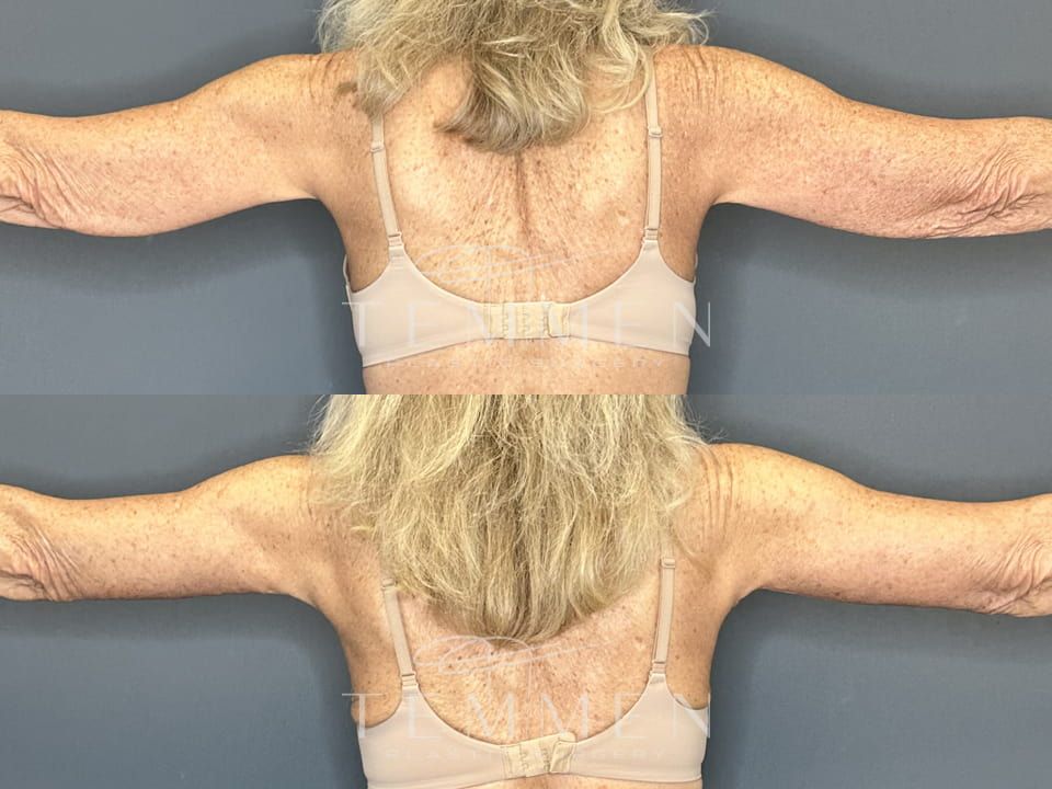 Arm Lift Before & After