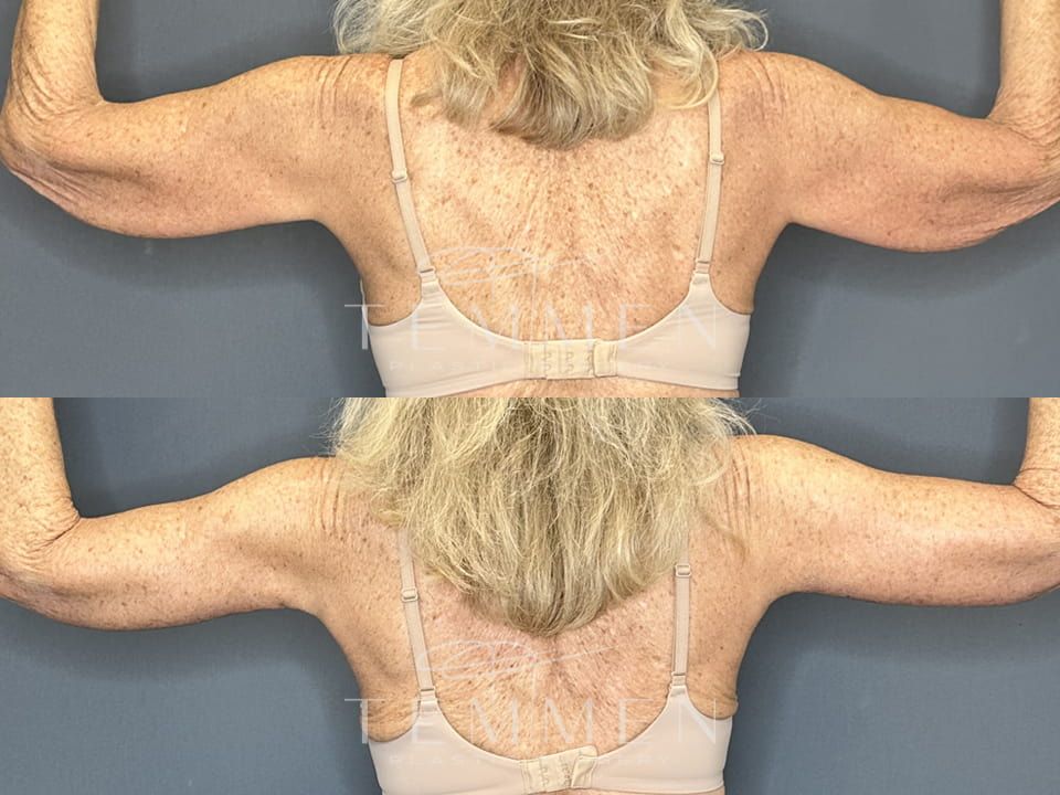 Arm Lift Before & After