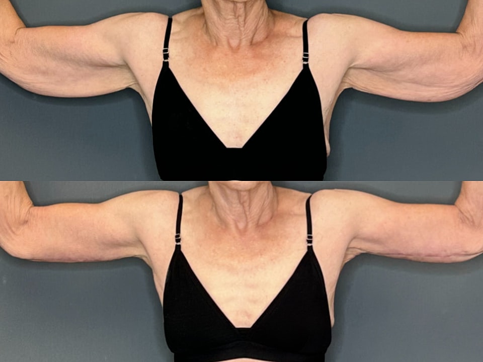 Arm Lift Before & After