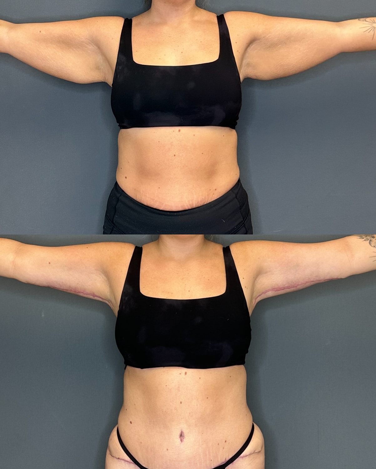 Arm Lift Before & After