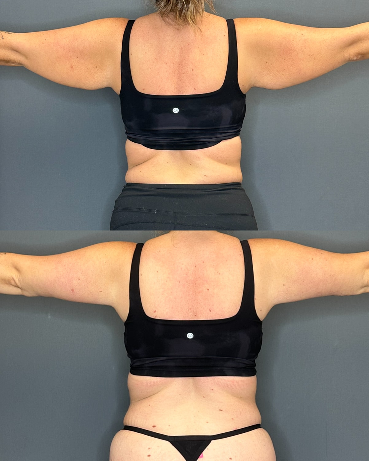 Arm Lift Before & After