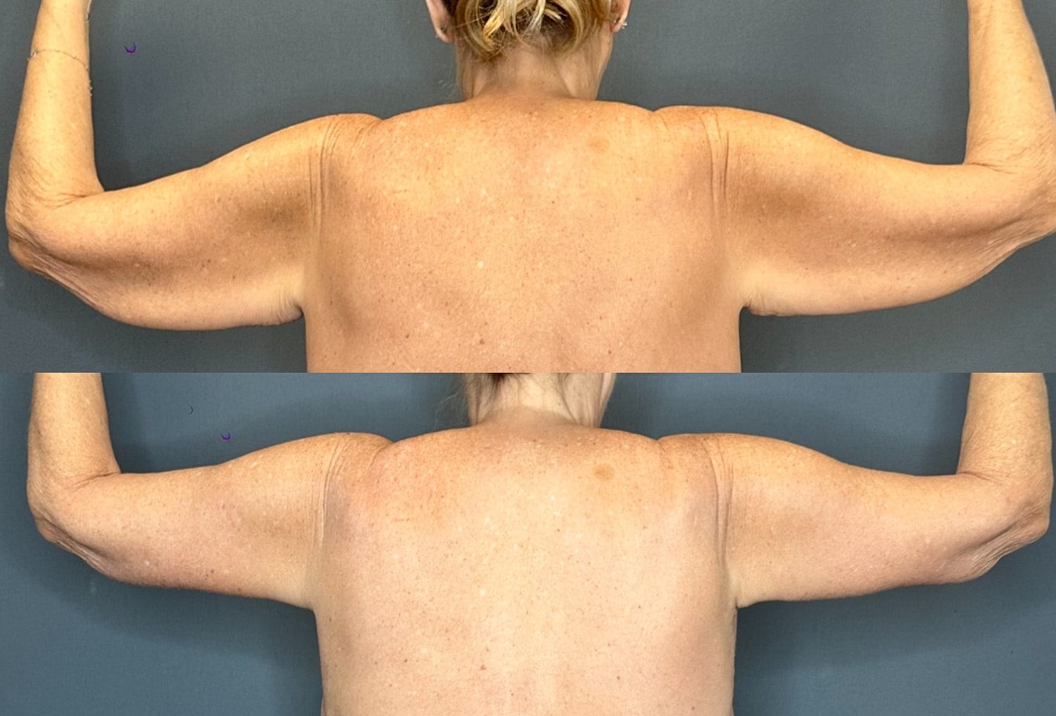 Arm Lift Before & After