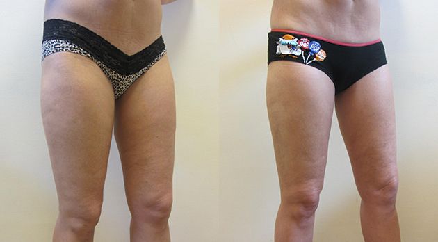Mini Thigh Lift Before & After