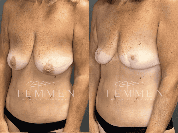 Breast Lift Before & After