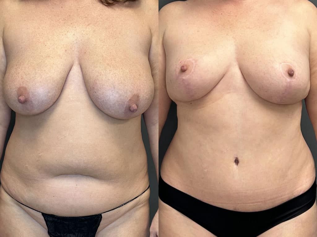 Breast Lift Before & After