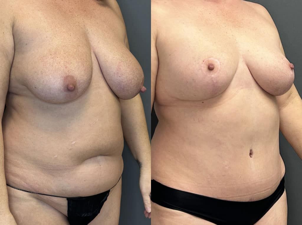 Breast Lift Before & After