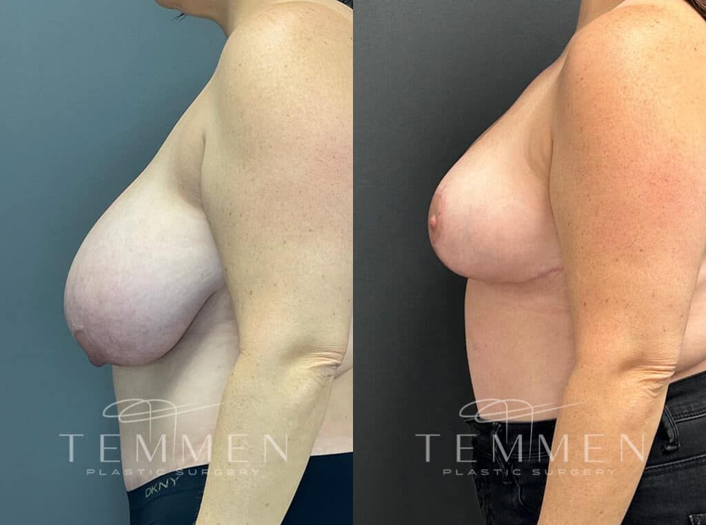 Breast Lift Before & After
