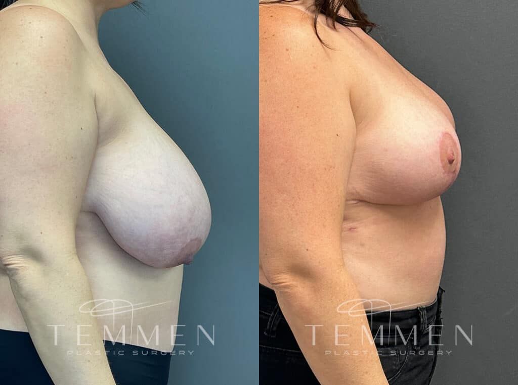 Breast Lift Before & After