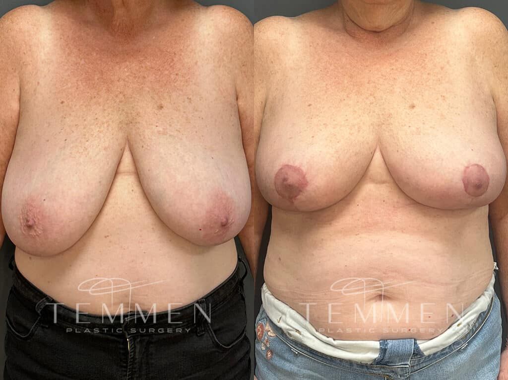 Breast Lift Before & After