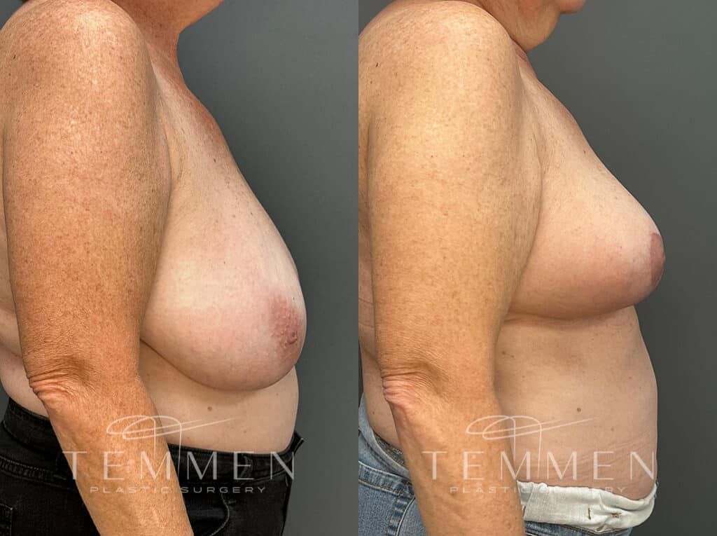 Breast Lift Before & After