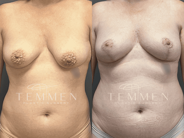 Breast Lift Before & After