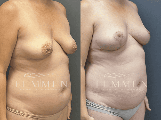 Breast Lift Before & After