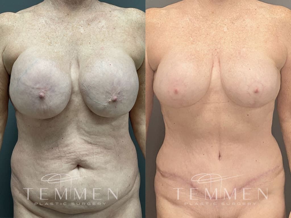 Breast Lift Before & After