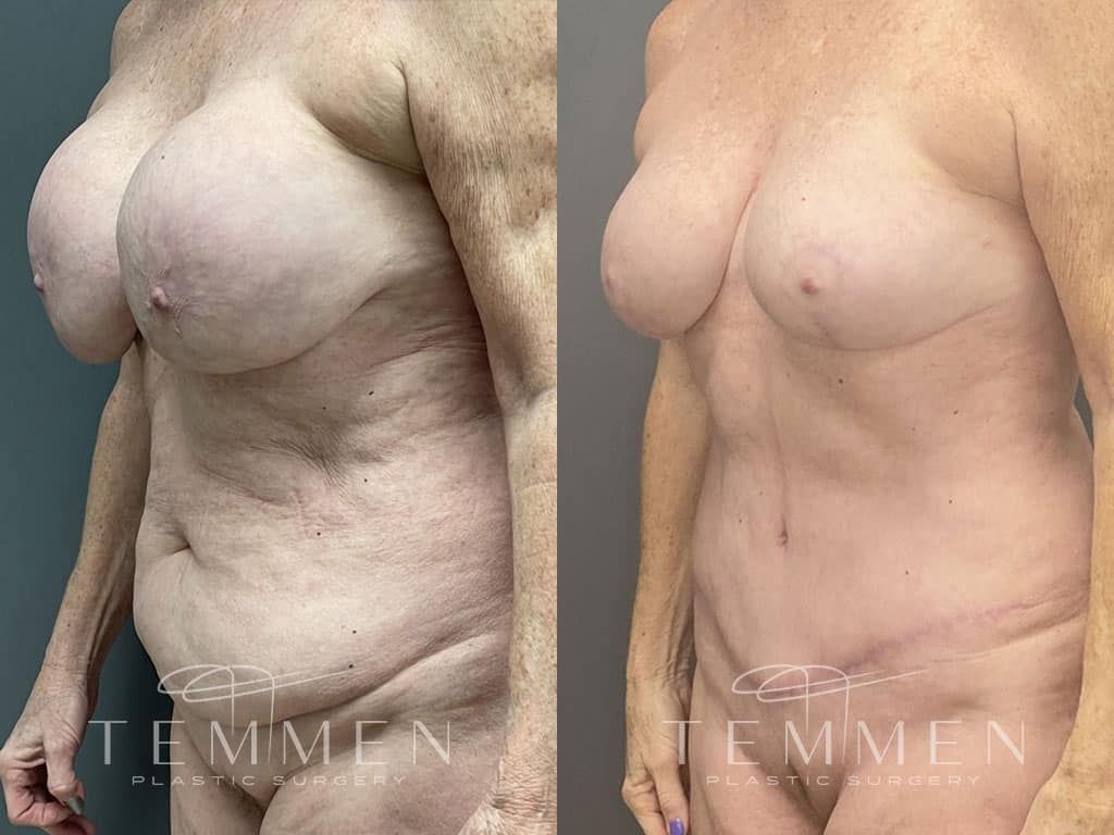 Breast Lift Before & After